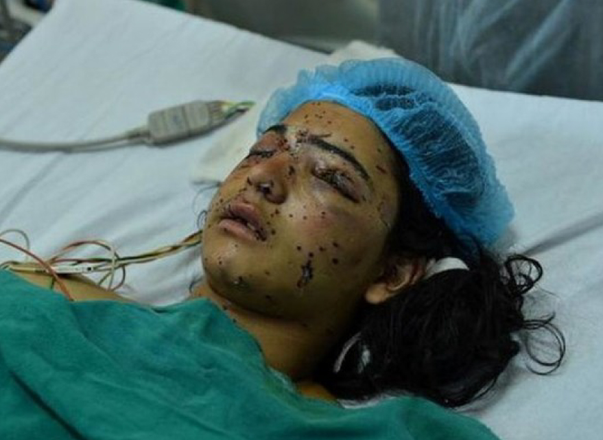 Insha Malik, the 14 year old victim of Indian Army's use of indiscriminate pellet attack in Kashmir valley.