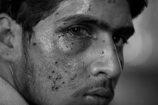 Pellet Victim Kashmir 081122