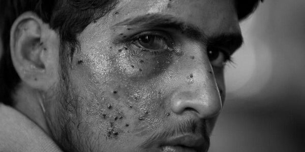 Pellet Victim Kashmir 081122